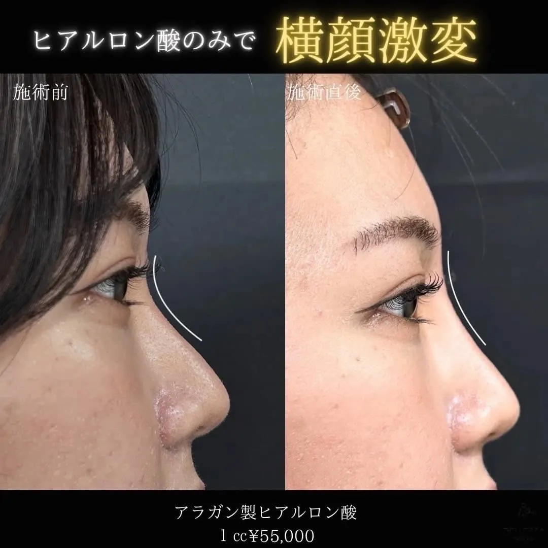 鼻ヒアルロン酸注入の症例写真（施術前・施術後・横顔）
