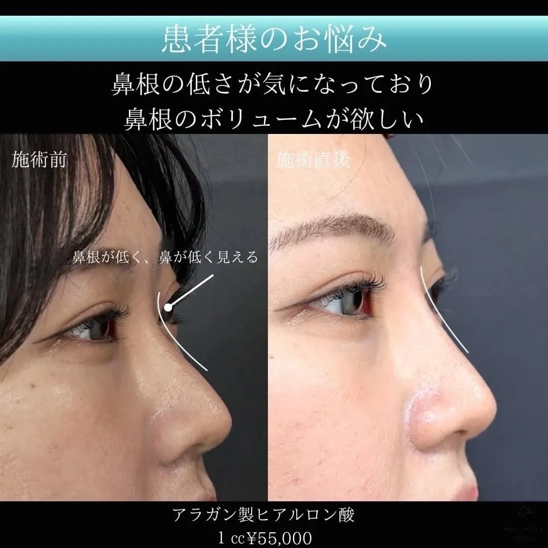 涙袋ヒアルロン酸注入の症例写真（施術前・施術後・斜め）