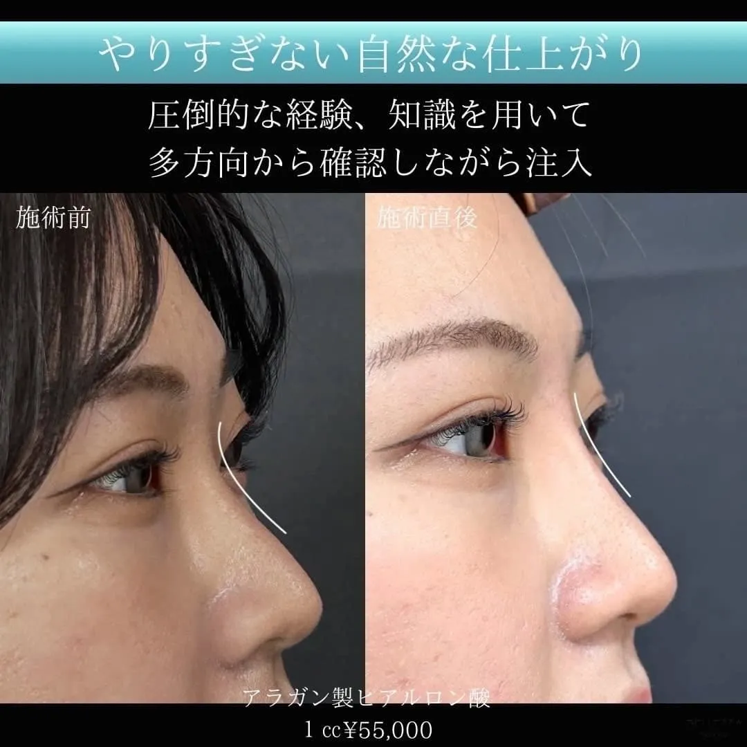 涙袋ヒアルロン酸注入の症例写真（施術前・施術後・斜め）