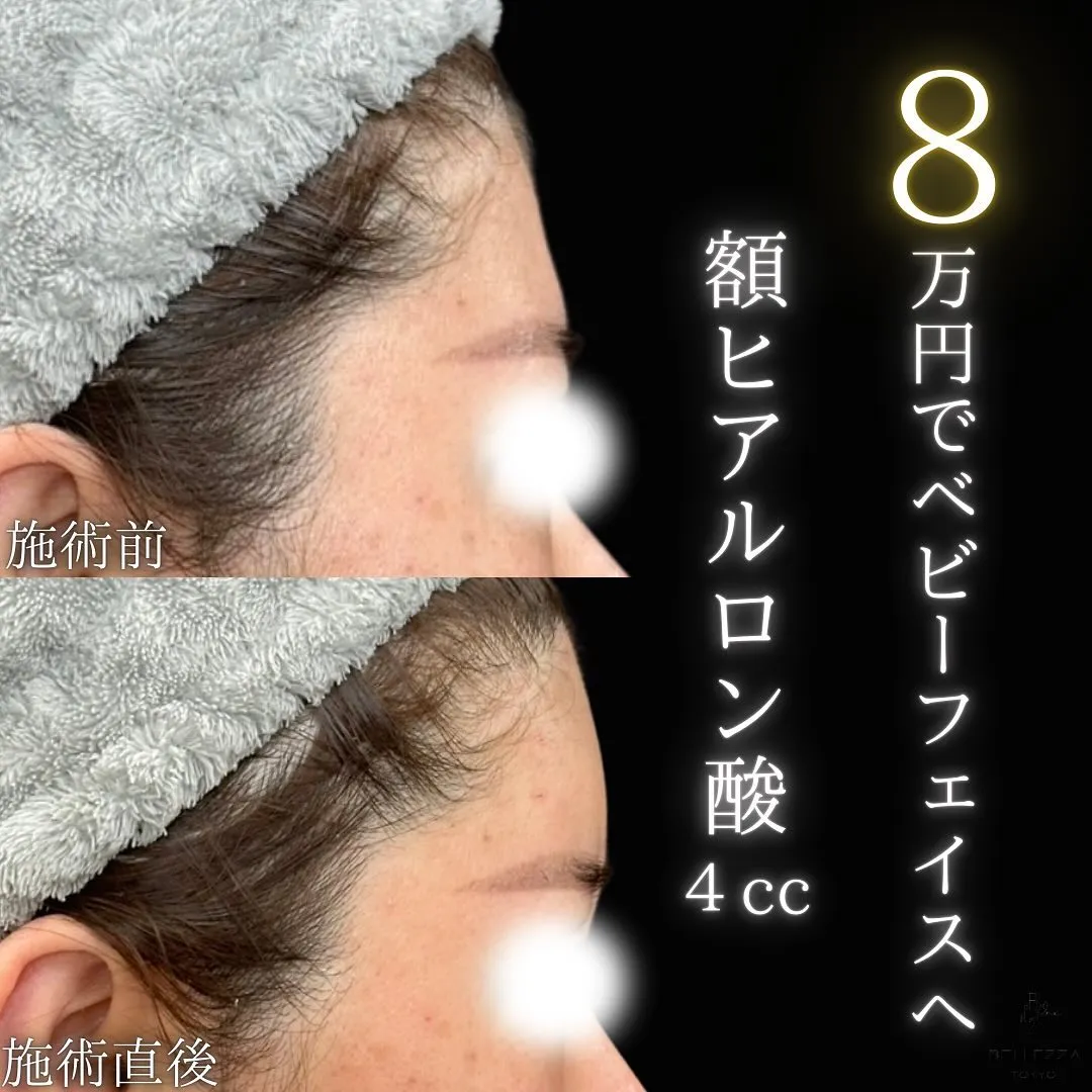 8万円でできる額ヒアルロン酸注入の症例写真（施術前・施術後・横顔）