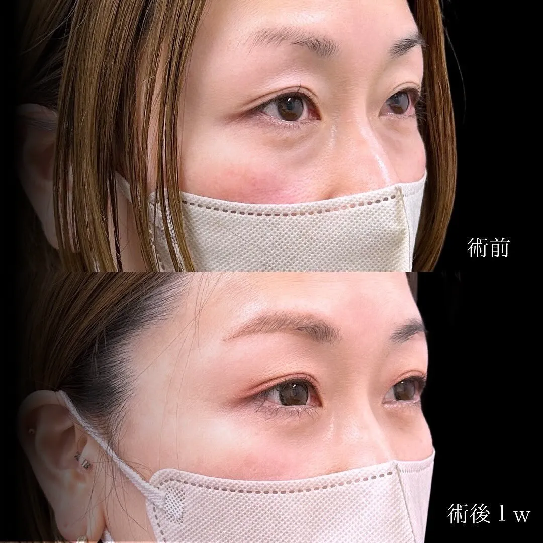 切らないクマ取りのアップ症例写真（施術前・施術後1週間後）