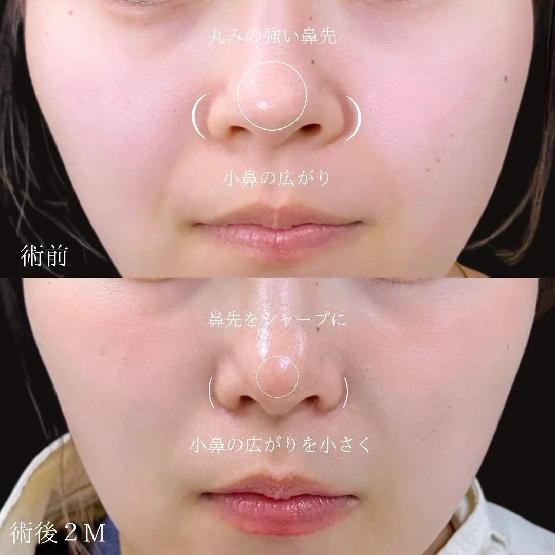 小鼻縮小と鼻尖形成の症例アップ写真（施術前・施術後2か月）