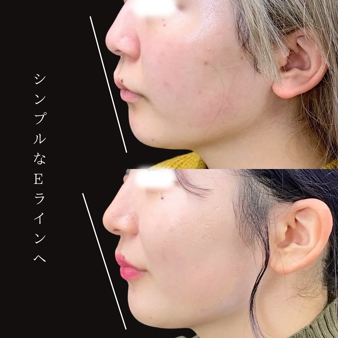 小鼻縮小と鼻尖形成のアップ症例写真（施術前・施術後）