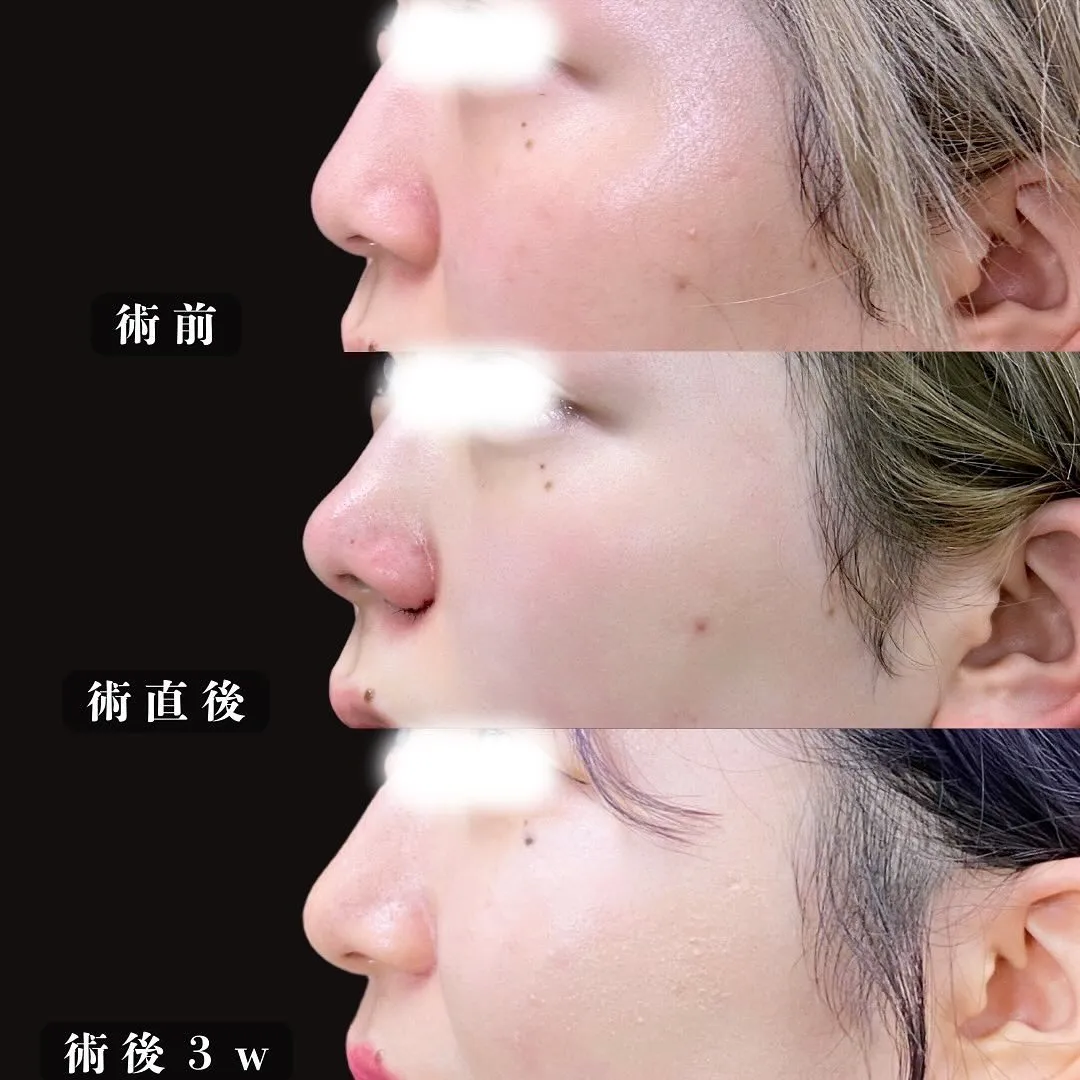小鼻縮小と鼻尖形成の症例写真（施術前・施術直後・施術後3週間）