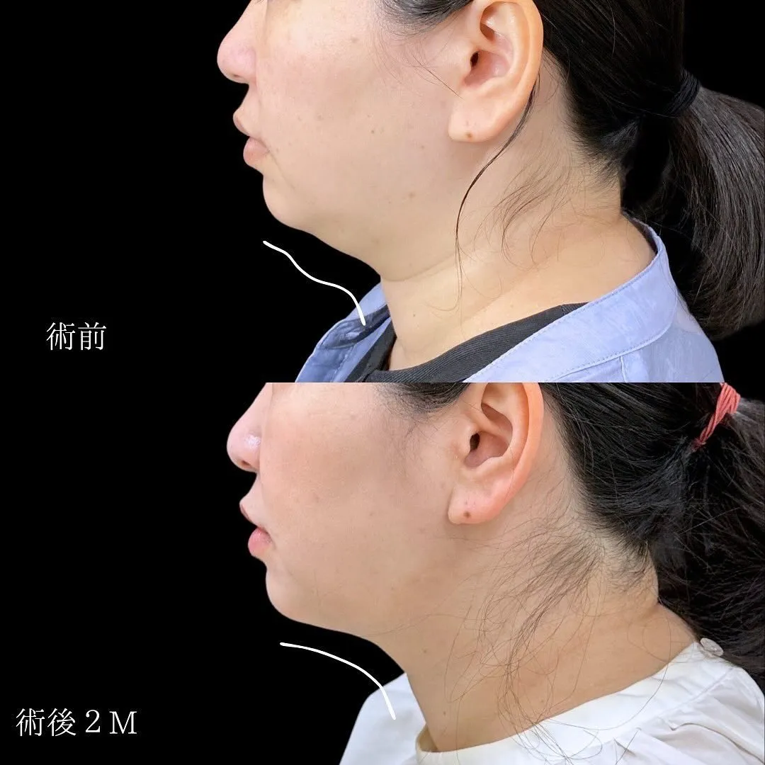 脂肪吸引(顎下)の症例写真（施術前・施術後2か月・横顔）