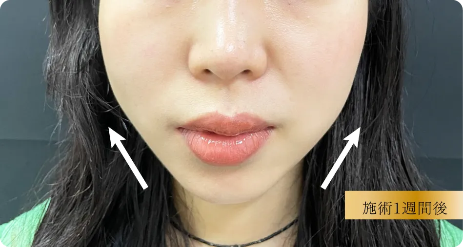東京ベレッザクリニック 糸リフト 施術後（若い女性の小顔・フェイスライン引き締め・1週間後）