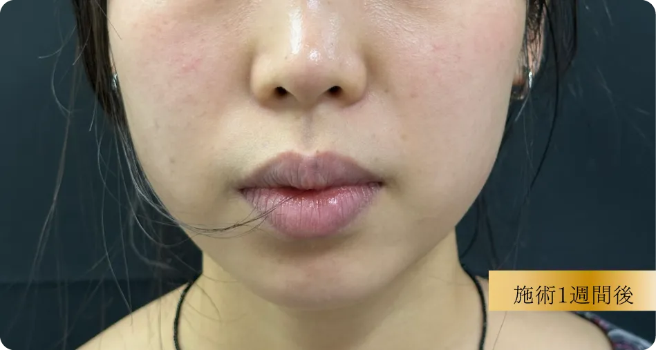 東京ベレッザクリニック 糸リフト 施術前（若い女性の小顔・フェイスライン引き締め）