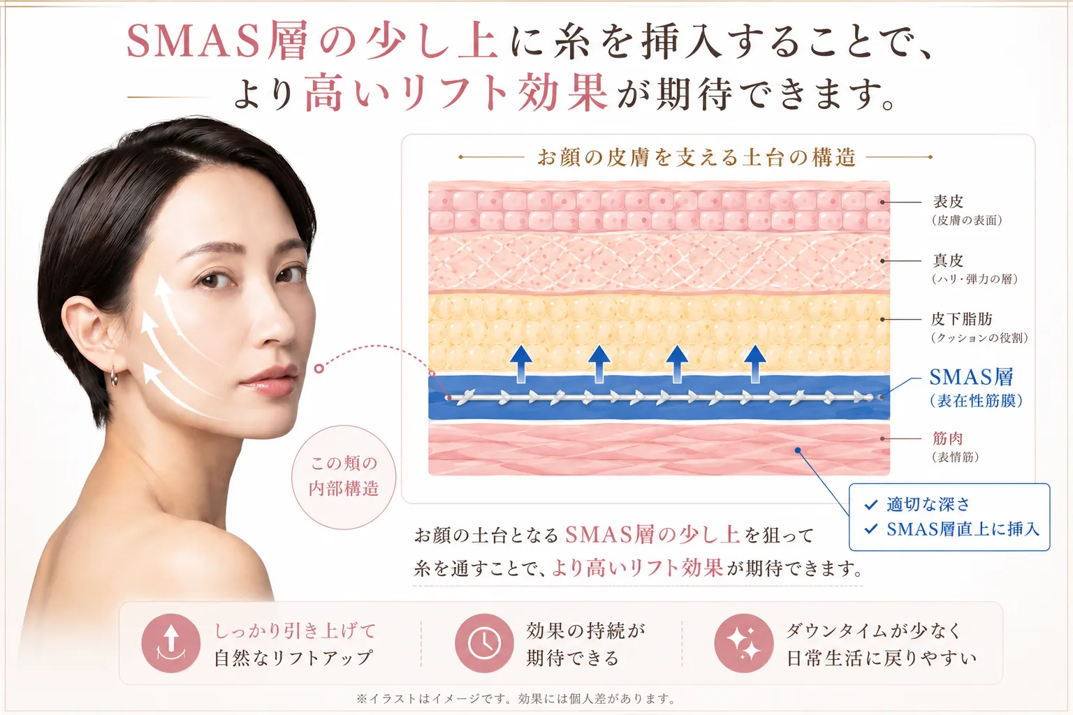 SMAS層の少し上に糸を挿入するリフトアップ効果の仕組み解説図