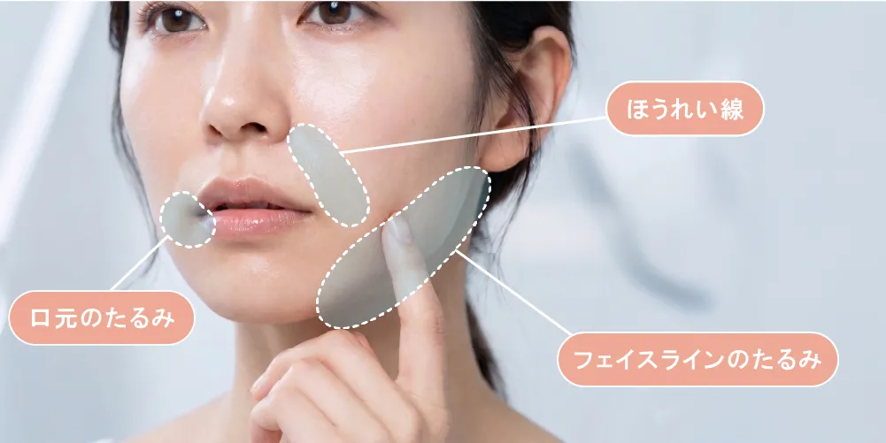 ほうれい線、口元のたるみ、フェイスラインのたるみに悩む20代後半女性