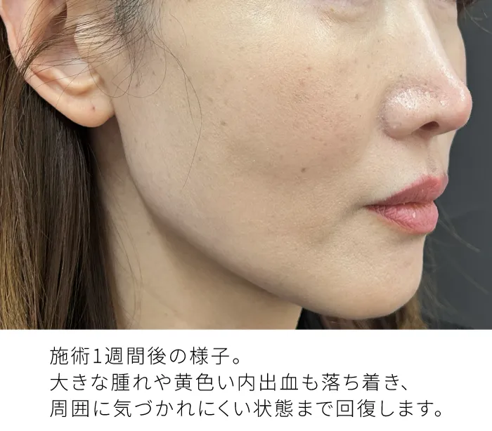 丁寧かつ手早い施術によるダウンタイム軽減イメージ